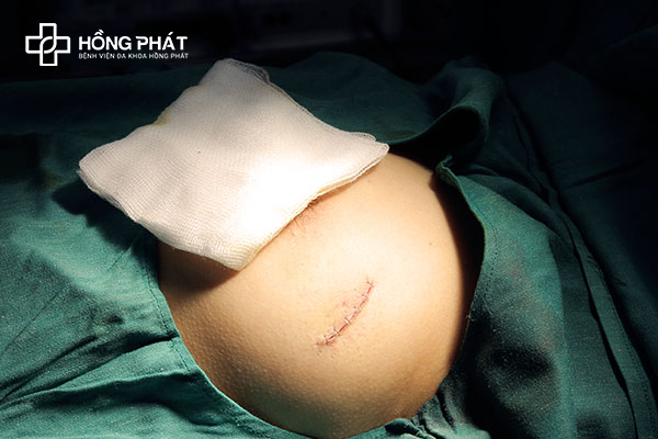 Phẫu thuật u nang vú trái - Bệnh viện Đa khoa Hồng Phát