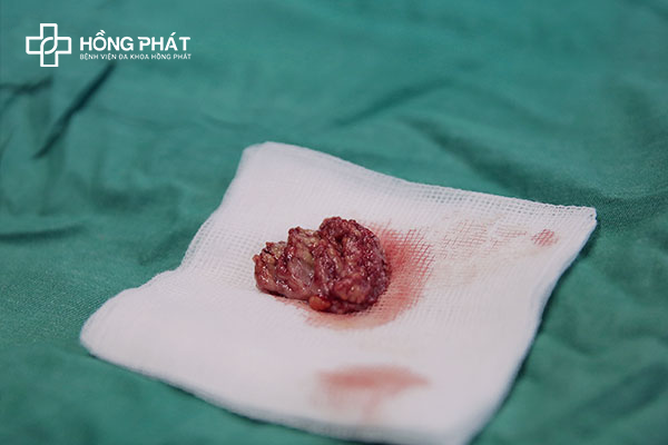 Phẫu thuật u nang vú trái - Bệnh viện Đa khoa Hồng Phát 2