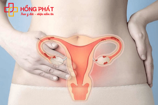 Lạc nội mạc tử cung là căn bệnh có thể gây vô sinh ở phụ nữ