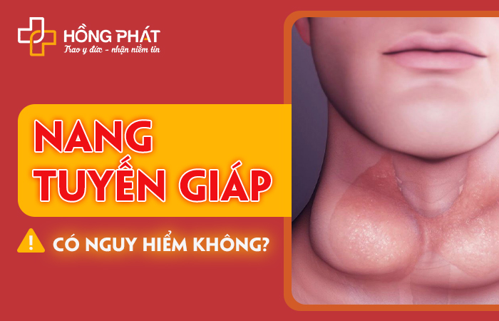 Nang Tuyến Giáp Có Nguy Hiểm Không? Giải Đáp Và Phương Pháp Điều Trị Hiệu Quả