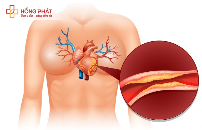 Nguyên nhân, triệu chứng xơ vữa động mạch 