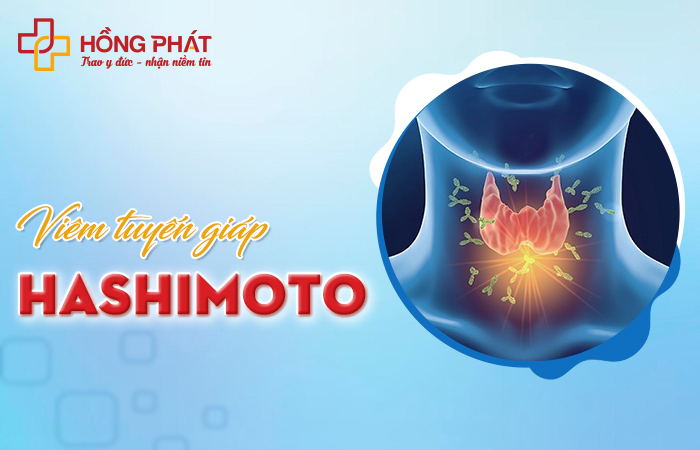 Viêm tuyến giáp Hashimoto